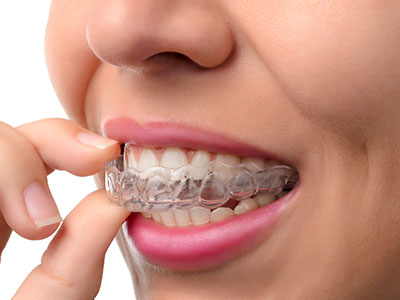 A person holding a clear plastic dental retainer to their mouth.