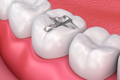 The image shows a close-up view of a human dental implant, which is a small metal screw, placed within the gum line to support an artificial tooth.