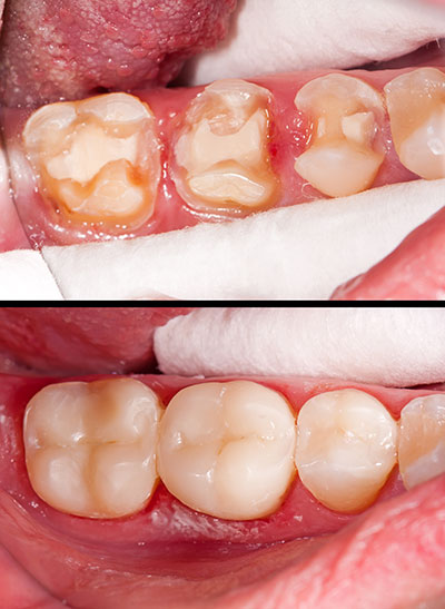 The image shows a close-up of a person s mouth with teeth that appear to be in poor condition, likely due to decay or gum disease. The teeth are discolored and some have cavities, indicating the need for dental care.