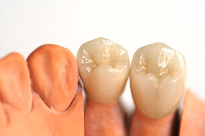 An image of two artificial tooth models, one with a natural tooth appearance and the other with a brownish hue, displayed against a white background.