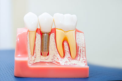 The image shows a close-up of a dental implant fixture with multiple teeth models attached to it, placed on a pink plastic base that appears to be a dental implant guide or model.