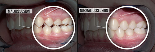 The image shows a side-by-side comparison of a person s teeth before and after a dental procedure, with annotations indicating the transformation from  normal occlusion  to  malocclusion.