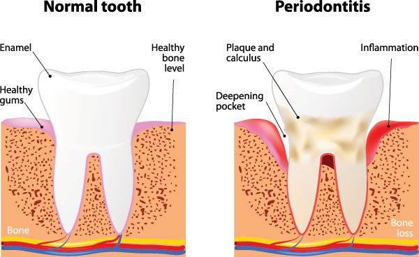 The image is a medical illustration showing the stages of periodontitis, from normal to severe, with annotations explaining each stage.