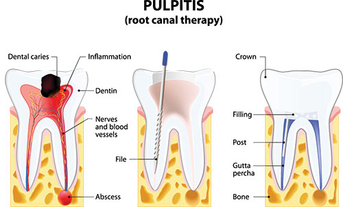 The image is a detailed medical illustration showing the structure of a tooth and its root canal therapy, with labels indicating different parts of the dental anatomy.