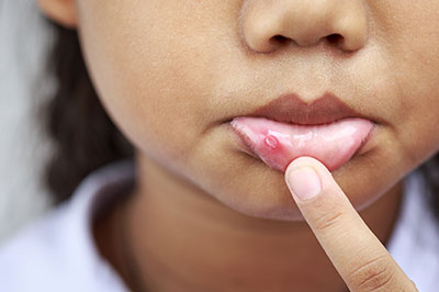 The image shows a close-up of a person s face with a focus on their lips, which appear to be swollen or irritated.