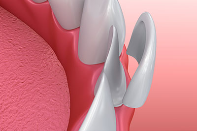 The image displays a close-up view of a dental implant, which is a small, metallic screw that attaches to the jawbone and serves as an artificial tooth root.