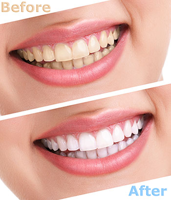 The image shows a before-and-after comparison of teeth whitening, with the  before  showing yellowed teeth and the  after  displaying bright white teeth.