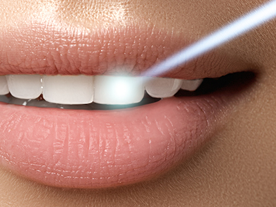 The image is a close-up advertisement featuring a person s lips with a focus on the teeth, showcasing a product that appears to be related to dental care or cosmetics.