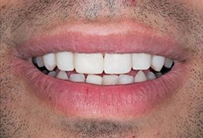The image shows a close-up of a person s mouth with teeth, displaying a smile.