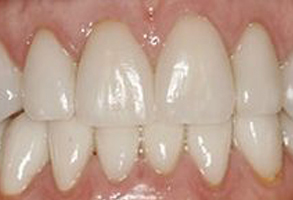 The image shows a close-up of a person s teeth, with a focus on the upper front teeth.